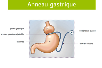 anneau gastrique